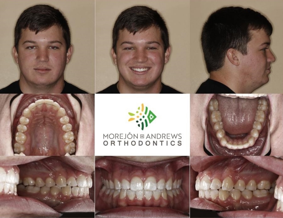 Results from orthodontics at Morejon + Andrews Orthodontics. Beautiful smiling teeth at different angles
