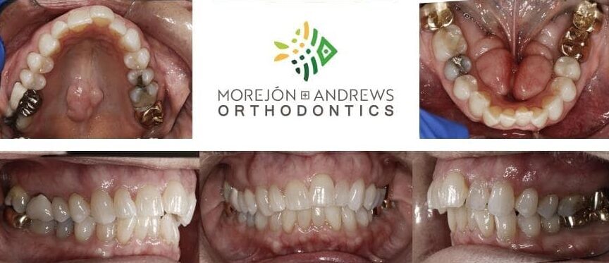 senior patient invisalign before and after pics