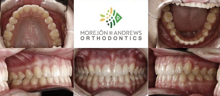 invisalign teen before and after pics