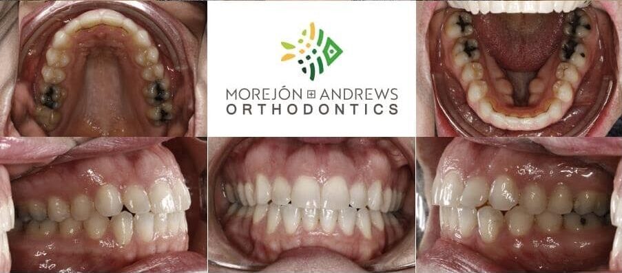 adult patient invisalign before and after pics