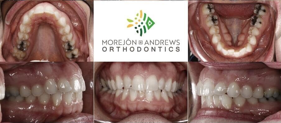 adult with narrow dental arches invisalign before and after pics