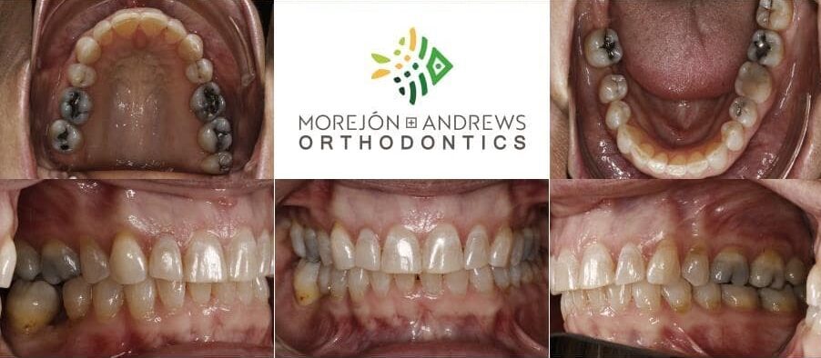 white female adult invisalign before and after pics