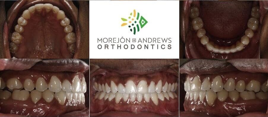 african american adult invisalign before and after pics