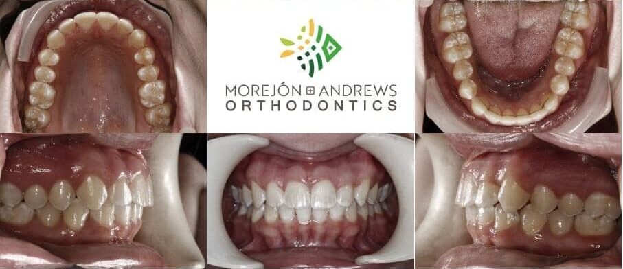 adult invisalign before and after pics