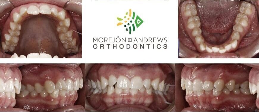 ormond beach ortho patient invisalign before and after pics