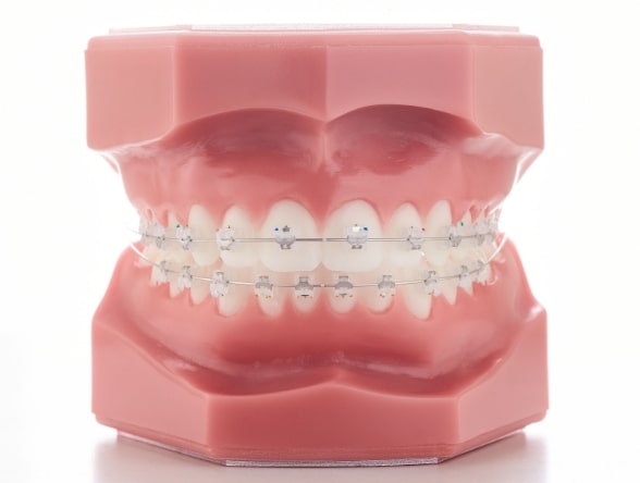 Model of teeth wearing ceramic clear braces at Morejon + Andrews Orthodontics