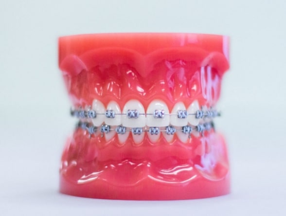 Model of teeth with gums, wearing metal braces with colorful rubber bands at Morejon + Andrews Orthodontics