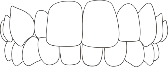 Icon showing a crossbite in teeth, some top teeth overlapping bottom teeth in front and behind
