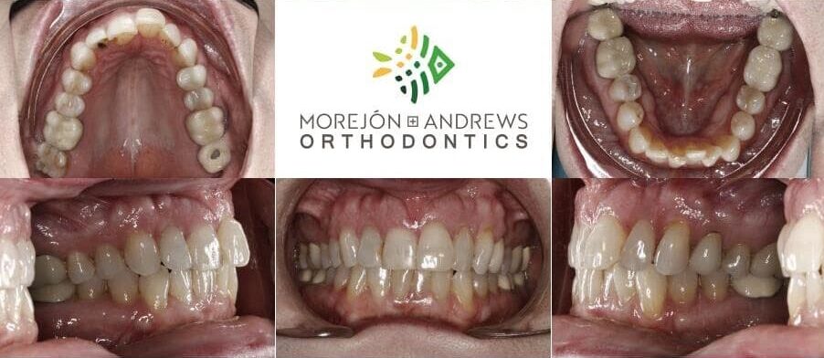 senior adult invisalign before and after pics