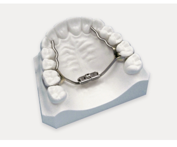 palatal expander on teeth model