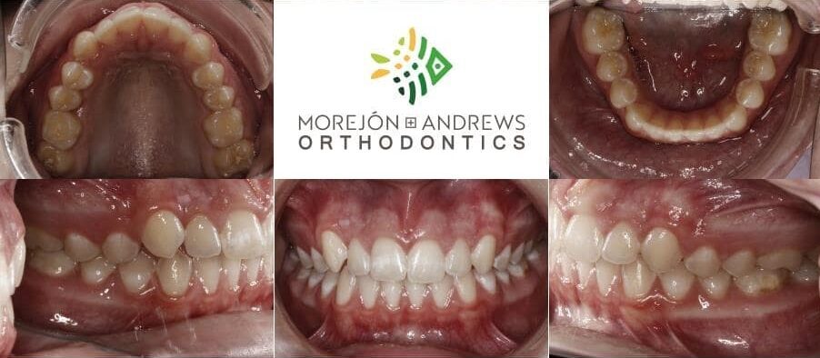 child invisalign before and after pics