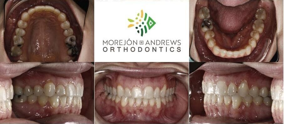 adult with crooked tooth corrected invisalign before and after pics
