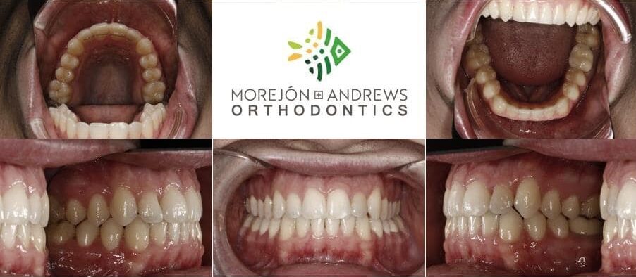 guy with front crowding corrected invisalign before and after pics