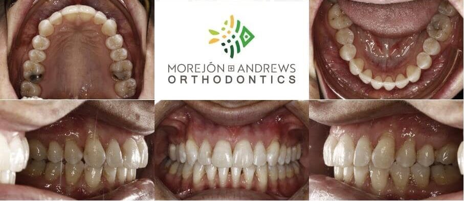 adult with corrected crowded teeth invisalign before and after pics