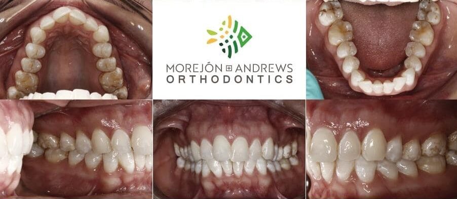 adult with crooked teeth invisalign before and after pics