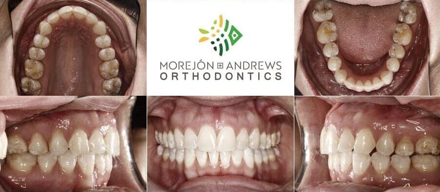adult with overbite invisalign before and after pics