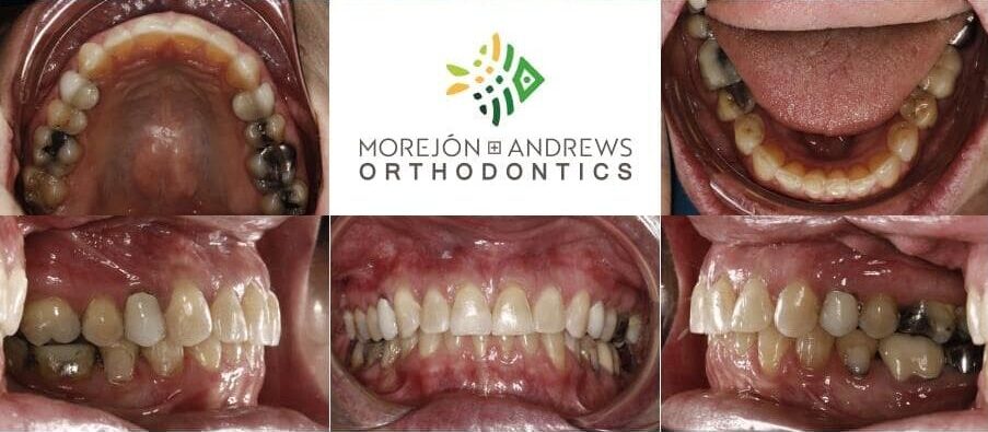 senior with corrected spacing issues invisalign before and after pics