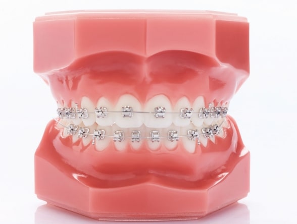 Model of teeth wearing metal braces at Morejon + Andrews Orthodontics