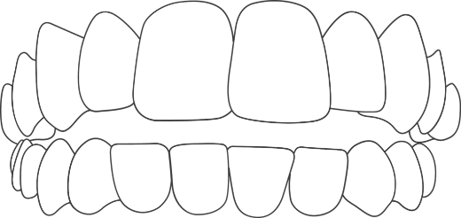 icon showing open bite in teeth, top teeth not closing properly with bottom teeth