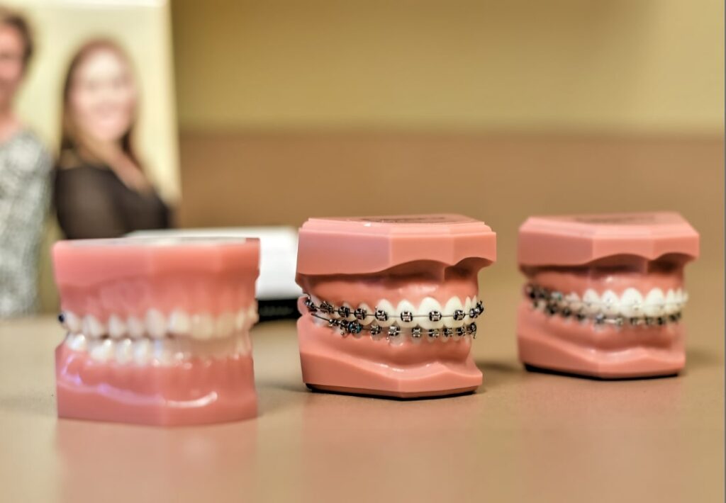 Three models of teeth wearing different types of braces, one with clear aligners, one with metal braces, one with clear braces, at the Morejon + Andrews Orthodontics orthodontist office
