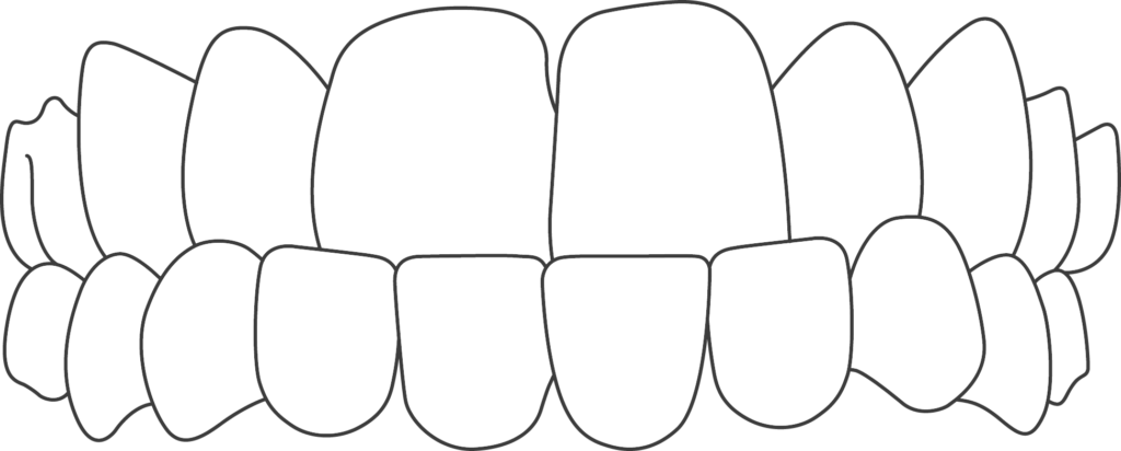 Icon showing an underbite in teeth